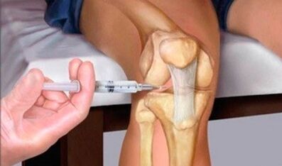 Hyaluronic acid with knee wrist arthrosis