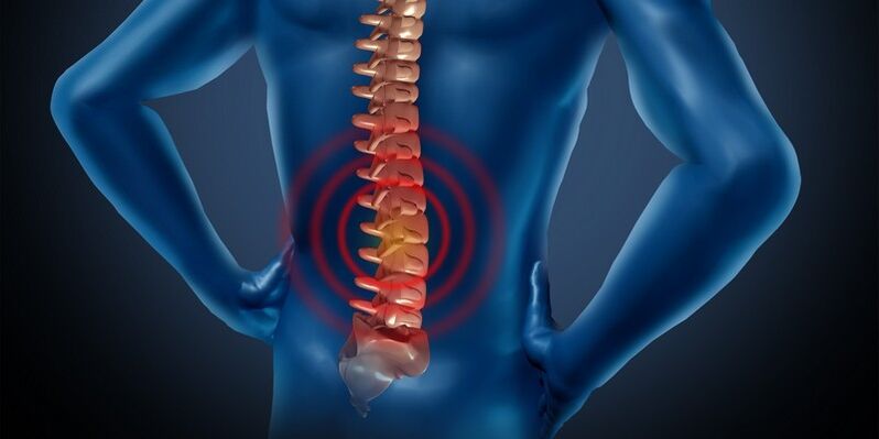 Osteochondrose of the lumbar region