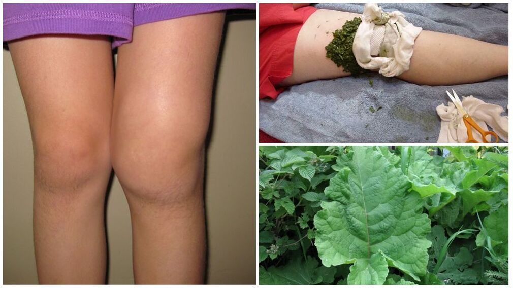 Compression on the knee with thistle - a folk method of treating gonarthrosis