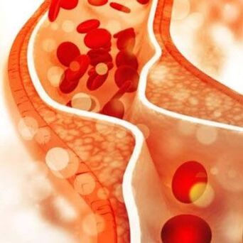 Cholesterol deposition on the inner walls of blood vessels causes pain in the side of the neck